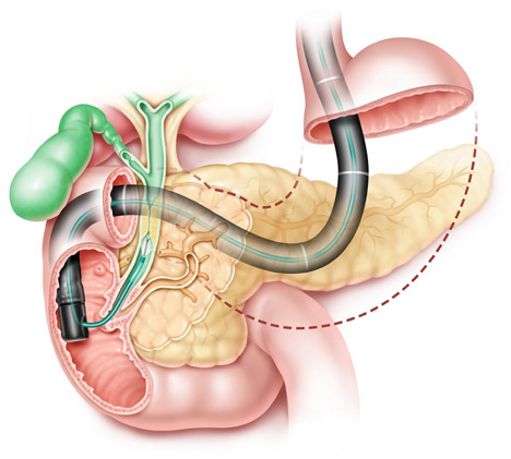 ERCP