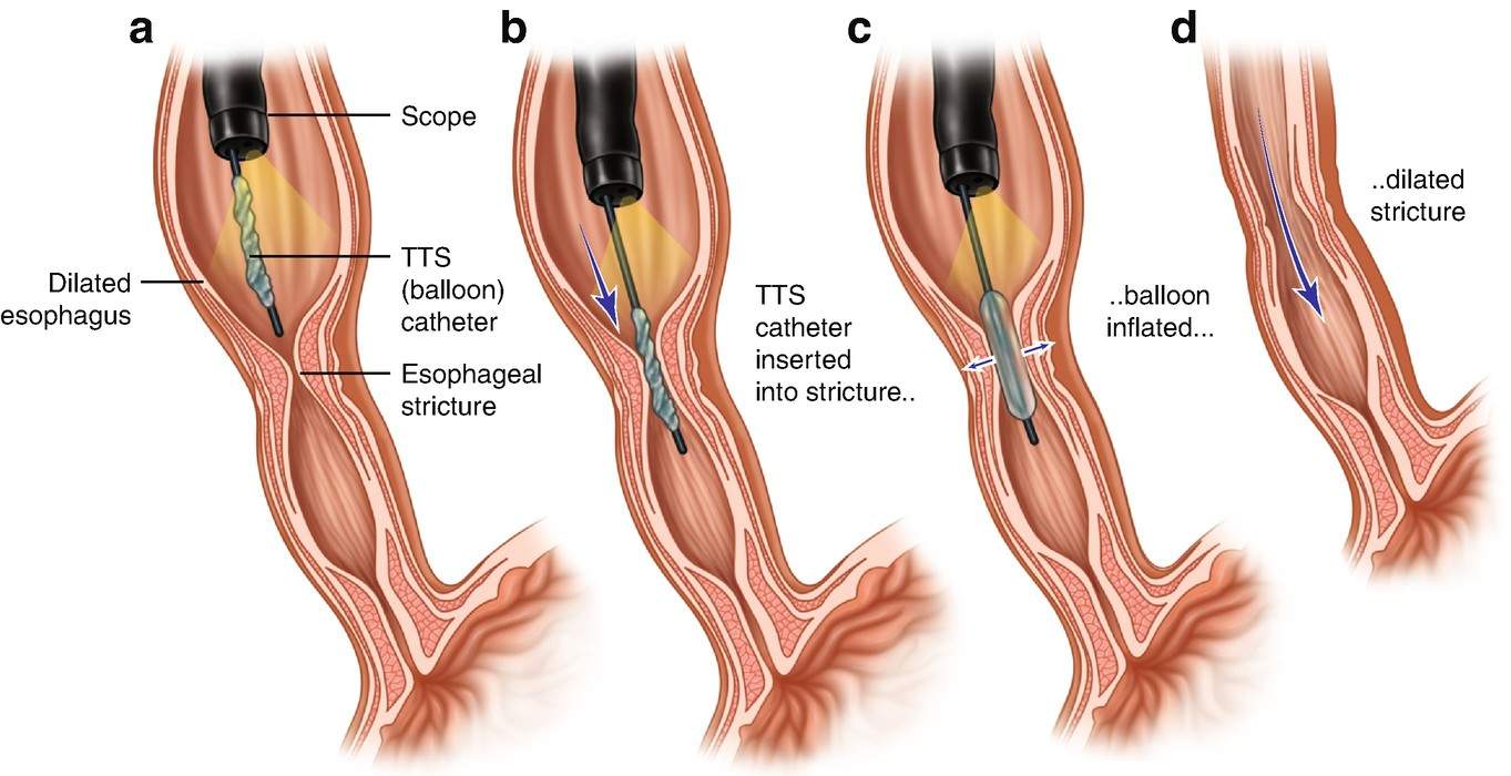 Esophageal Colonic Stricture Dilation