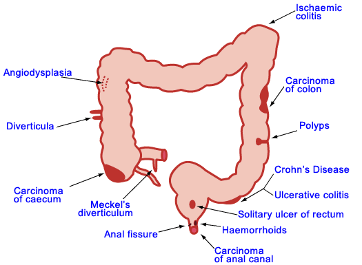 Gastrointestinal Bleeding