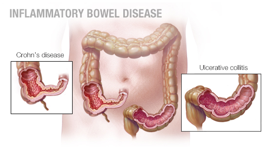Inflammatory Bowel Disease Management