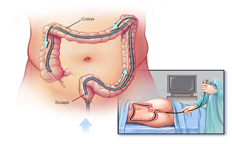 Colonoscopy