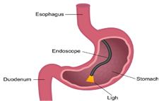 Gastroscopy