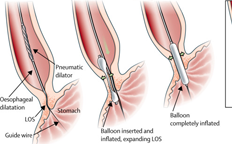 Achalasia Cardia Dilatation