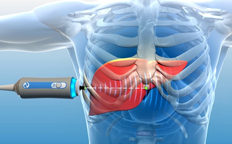 Liver Fibroscan